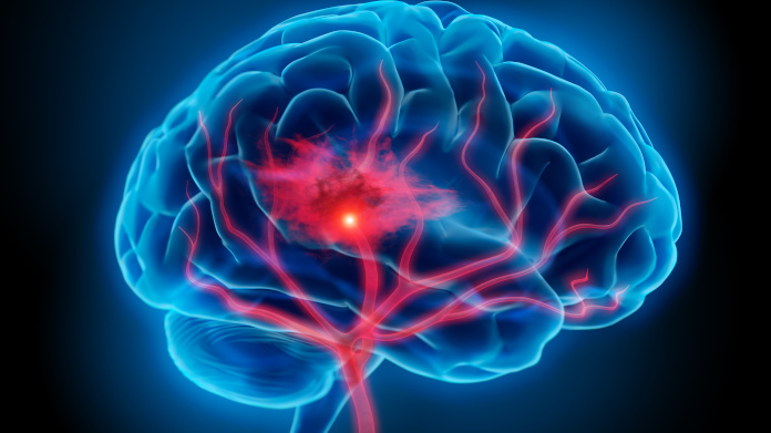 Blood vessel rupturing in the brain