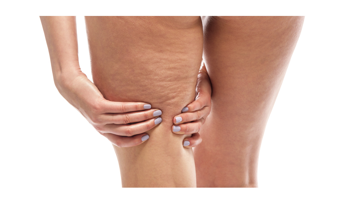 Jambe de femme avec cellulite