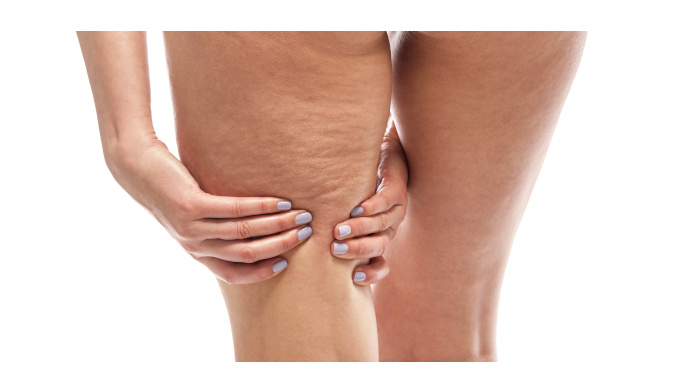 Vrouwenbeen met cellulite