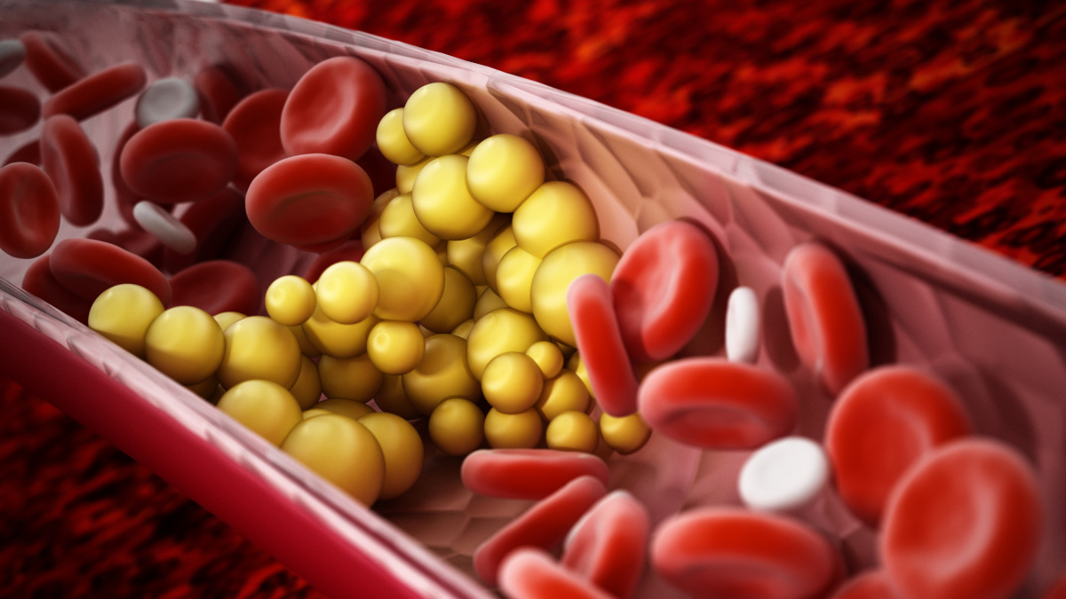 Colesterol mau LDL que entope as artérias