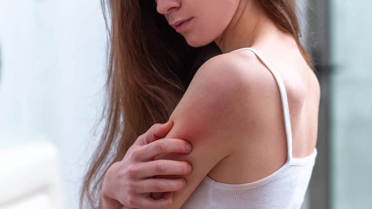 Mulher com eczema atópico a coçar o braço